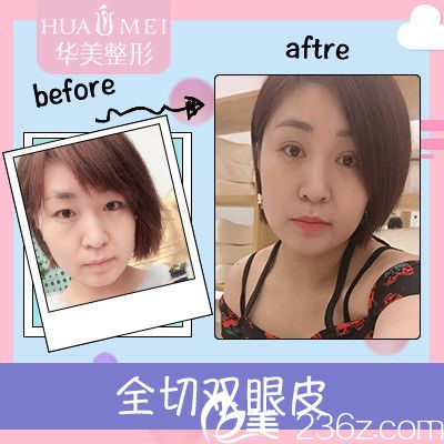 汕头华美蒋友宁双眼皮案例