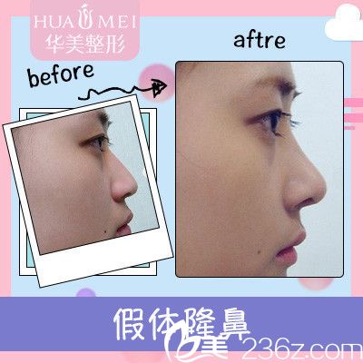 汕头华美田学勤隆鼻案例