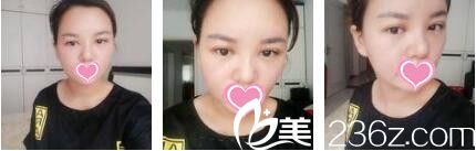 一口气在上海奉浦做了双眼皮+鼻综合+面部脂肪填充，变美就需要这么直接