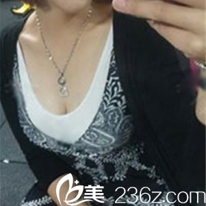 在绍兴艺美整形这花3W多做假体和自体脂肪复合隆胸的这半年时间里,没一天后悔过
