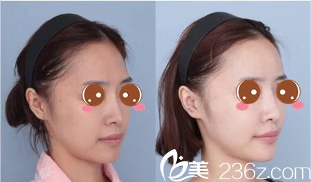 韩国媄琳皮肤整形医院崔濬自体脂肪面部填充真人案例 韩国媄琳皮肤整形医院崔濬自体脂肪面部填充真人案例