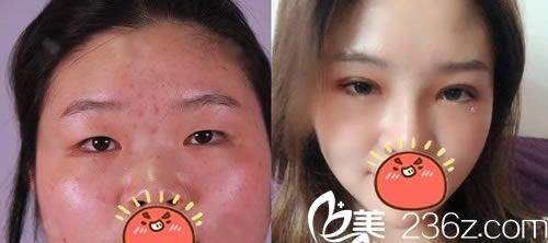 宁波113医院整形科金式伦双眼皮案例 宁波113医院整形科金式伦双眼皮案例