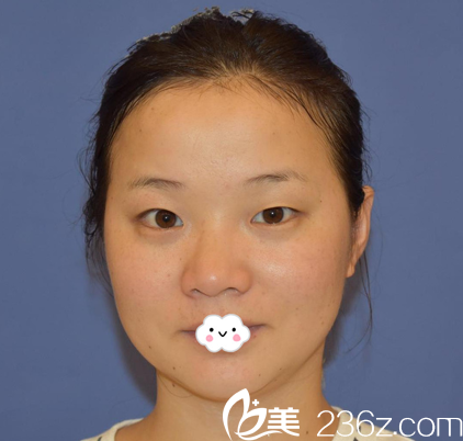 武汉壹加壹李艳东双眼皮真人案例 武汉壹加壹李艳东双眼皮真人案例