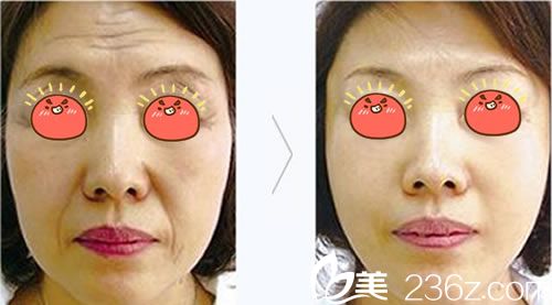宁波<!--<i data=20240703-sp></li>
<li><i data=20240703-sp></i>-->整形科马越波除皱案例