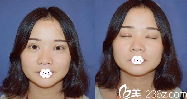 武汉壹加壹李艳东双眼皮+开眼角术后7天效果 武汉壹加壹李艳东双眼皮+开眼角术后7天效果