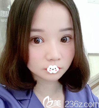 武汉壹加壹双眼皮术后1月恢复照片 武汉壹加壹双眼皮术后1月恢复照片