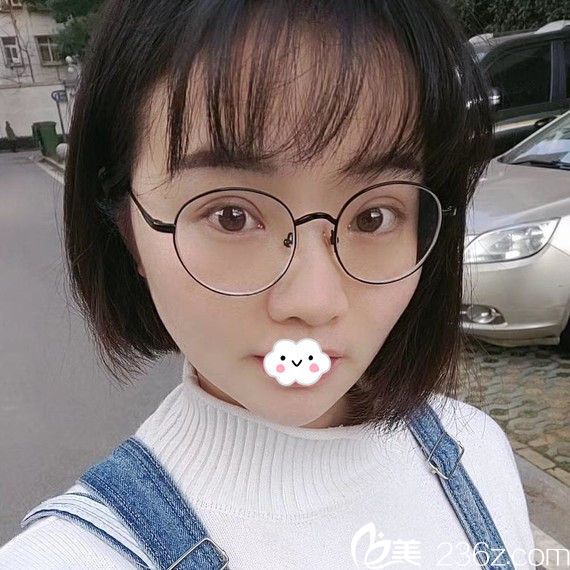 武汉壹加壹双眼皮真人案例术后效果图 武汉壹加壹双眼皮真人案例术后效果图