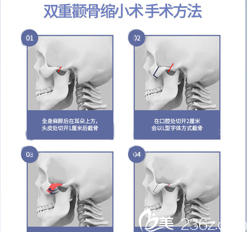 双重颧骨缩小手术方法 双重颧骨缩小手术方法