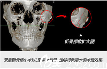 颧骨部位扩大图 颧骨部位扩大图