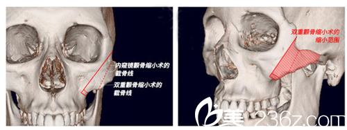 颧骨内推 颧骨内推