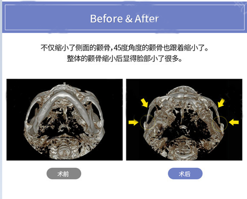 颧骨缩小手术前后对比 颧骨缩小手术前后对比