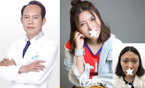 广西爱思特黎冻鼻整形失败修复案例