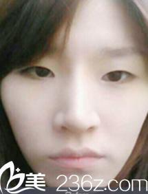 我在<!--<i data=20240703-sp></i>-->做双眼皮术前照片 我在<!--<i data=20240703-sp></i>-->做双眼皮术前照片