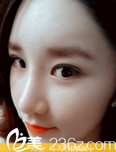 术后7天眼部变化情况 术后7天眼部变化情况