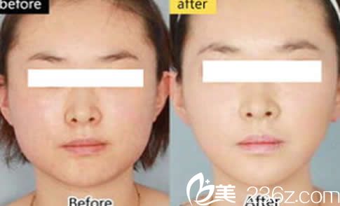 南宁爱思特面部吸脂10天恢复效果图