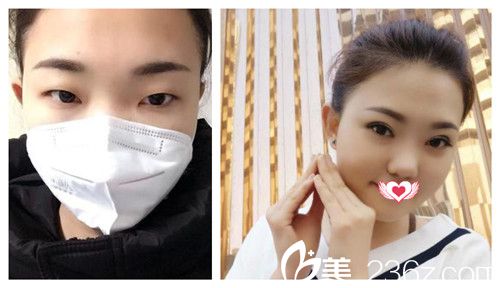 想在2019年提前超值变美 来看石家庄天伊美内含880元双眼皮的优惠价格表