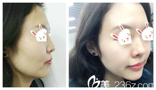 石家庄天伊美做隆鼻案例 石家庄天伊美做隆鼻案例