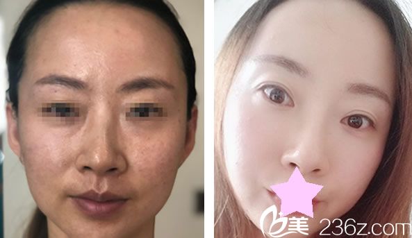 赵宏远面部线雕提升效果对比图 赵宏远面部线雕提升效果对比图