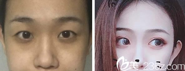 潘贰做眼综合+全切双眼皮效果对比图 潘贰做眼综合+全切双眼皮效果对比图