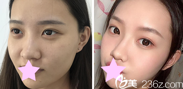 周诚主任做鼻综合+耳软骨隆鼻效果对比图 周诚主任做鼻综合+耳软骨隆鼻效果对比图