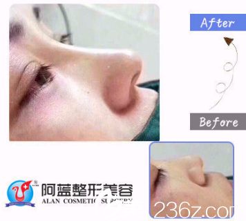 <!--<i data=20240703-sp></i>-->鼻综合术后效果对比 <!--<i data=20240703-sp></i>-->鼻综合术后效果对比