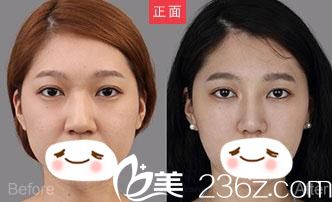 信阳易韩安和美容整形医院隆鼻手术效果图 信阳易韩安和美容整形医院隆鼻手术效果图