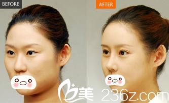 信阳易韩安和美容整形医院双眼皮手术效果图 信阳易韩安和美容整形医院双眼皮手术效果图