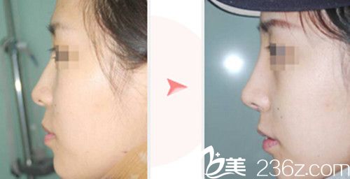 CELLA整形医院隆鼻案例 CELLA整形医院隆鼻案例