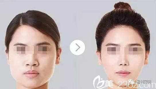 张院长所做的心形脸自体脂肪填充整形案例 张院长所做的心形脸自体脂肪填充整形案例