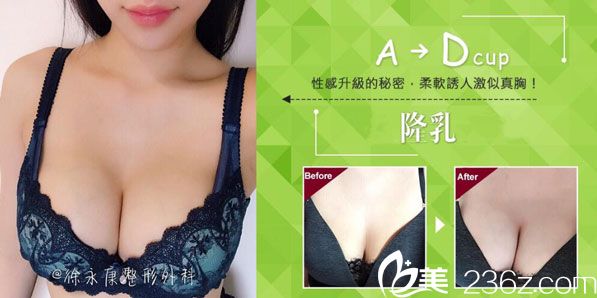 徐永康医师隆胸案例 徐永康医师隆胸案例