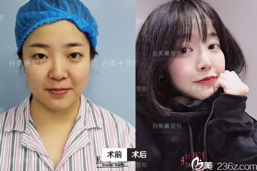 合肥哪家整形医院做眼综合好？合肥台美丽格整形用眼综合真实案例来说话