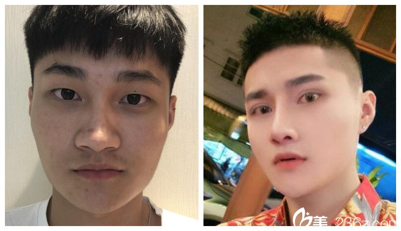 台美丽格整形穆威眼综合+鼻综合整形案例