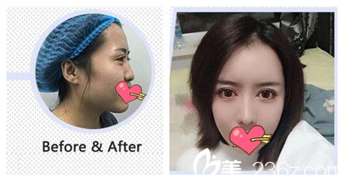 沈阳元辰陈军割双眼皮案例