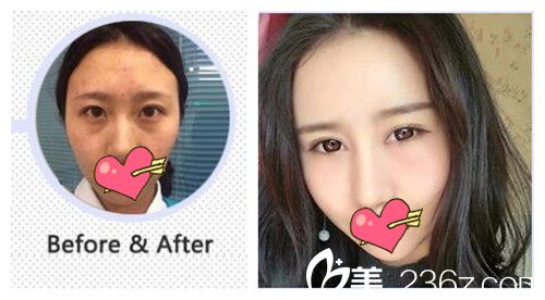 沈阳元辰谭臻田隆鼻对比图