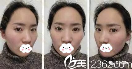 信阳易韩安和张鹤明做心形脸自体脂肪童颜术前 信阳易韩安和张鹤明做心形脸自体脂肪童颜术前