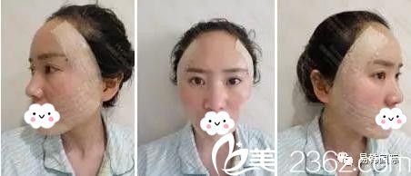 易韩安和美容整形医院张鹤明做自体脂肪填充后三天 易韩安和美容整形医院张鹤明做自体脂肪填充后三天