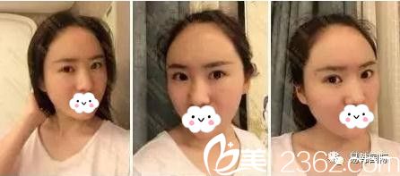 易韩安和美容面部脂肪填充术后四天 易韩安和美容面部脂肪填充术后四天