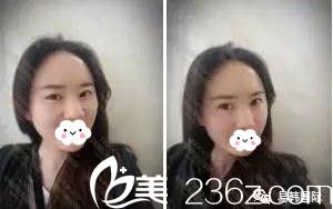 信阳做面部脂肪填充哪家医院好?看看我在易韩找张鹤明院长填充的心形脸效果就知道