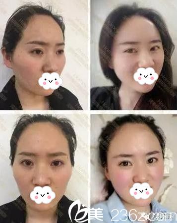 安和美容整形医院脂肪填充前后对比 安和美容整形医院脂肪填充前后对比