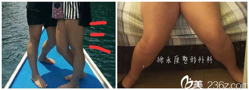 在中国台湾徐永康整形做吸脂前肥胖 在中国台湾徐永康整形做吸脂前肥胖