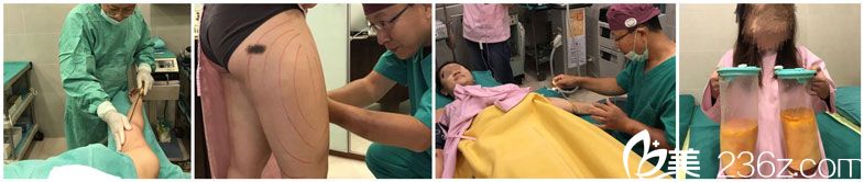 徐永康医生为我设计吸脂方案 徐永康医生为我设计吸脂方案