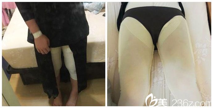 吸脂后穿着塑身衣 吸脂后穿着塑身衣