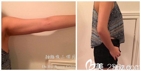 徐永康医生做三合一吸脂术后恢复三个月 徐永康医生做三合一吸脂术后恢复三个月