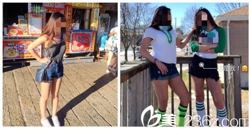 麒麟臂、粗壮腿找中国台湾徐永康医师做三合一抽脂术吸出3800cc恢复后告别吃酵素