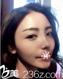 韩国nplus整形外科隆鼻技术怎么样 韩国nplus整形外科隆鼻技术怎么样