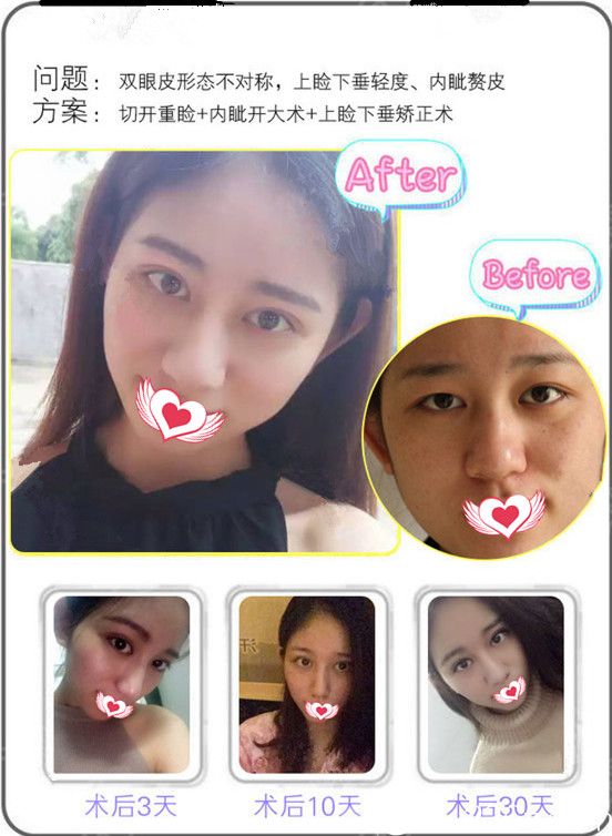 东莞美立方张克双眼皮恢复效果图 东莞美立方张克双眼皮恢复效果图