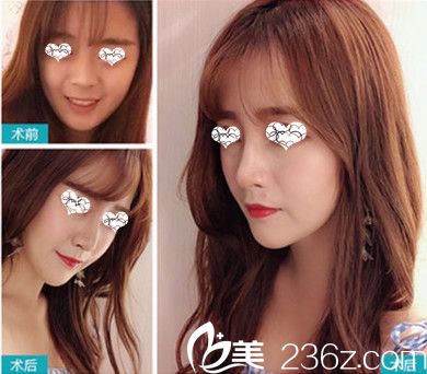 东莞美立方整形医院隆鼻前后对比图 东莞美立方整形医院隆鼻前后对比图