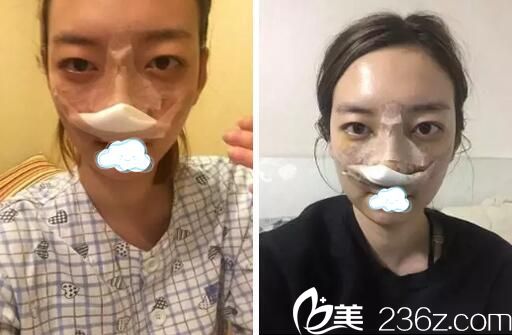 <!--<i data=20240703-sp></i>-->华美悦美整形鼻综合术后即刻