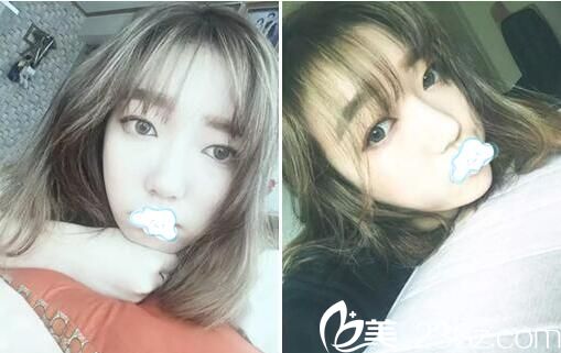 隆鼻手术后2个月恢复图片