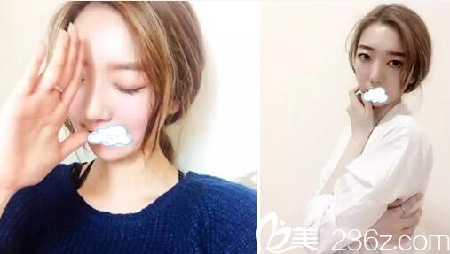 <!--<i data=20240703-sp></i>-->悦美鼻综合4个月恢复效果图